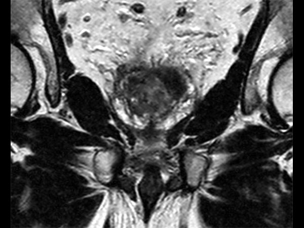 Coronal T2w TSE