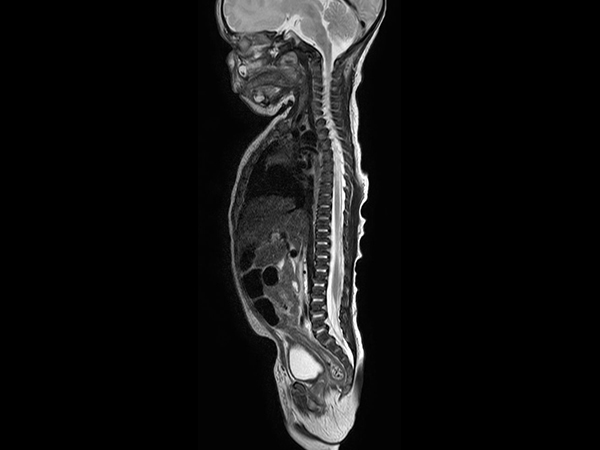 Sagittal T2w TSE