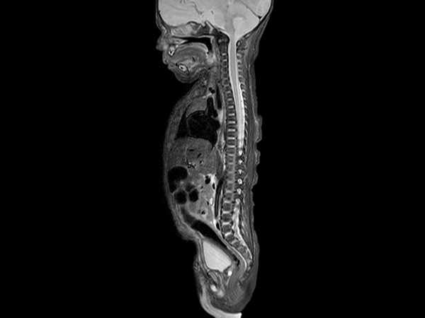 Sagittal STIR TSE