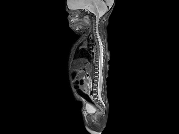 Sagittal STIR TSE