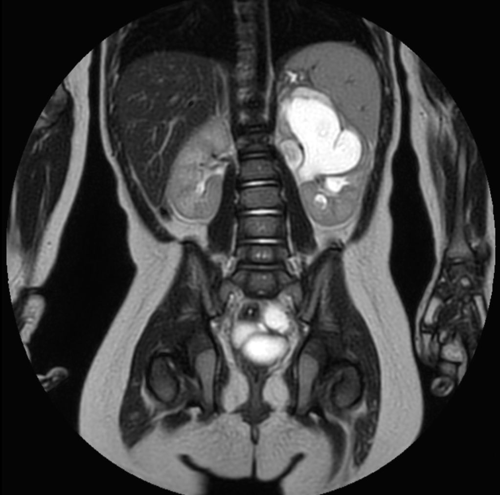 Coronal T2w MultiVane XD