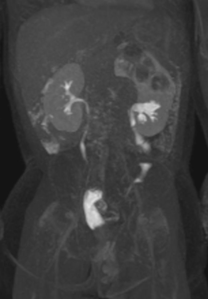 Coronal dynamic mDIXON XD - 9 min post-injection