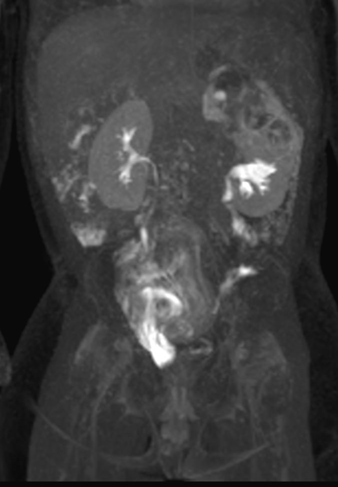 Coronal dynamic mDIXON XD - 12 min post-injection