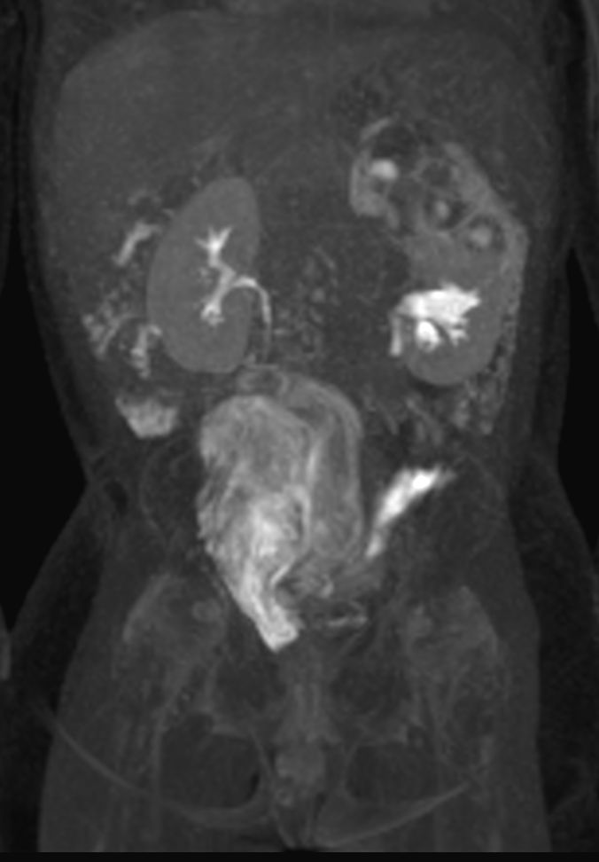 Coronal dynamic mDIXON XD - 15 min post-injection