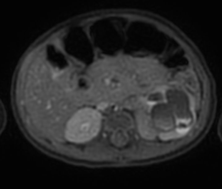 Axial T1w MultiVane XD SPIR with gado