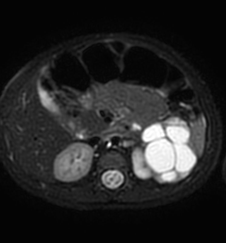 Axial T2w MultiVane XD SPAIR