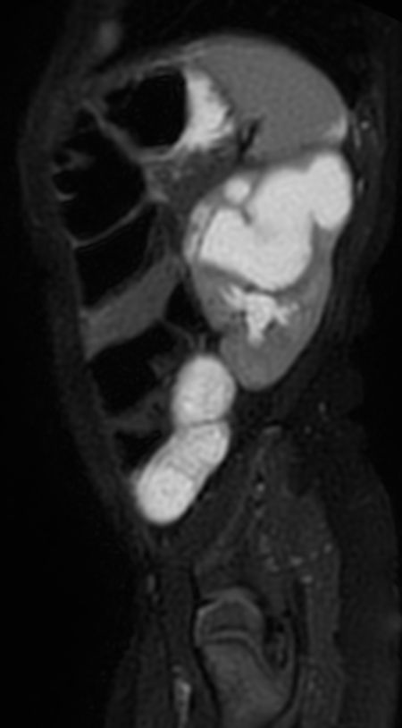 Sagittal T2w MultiVane XD SPAIR