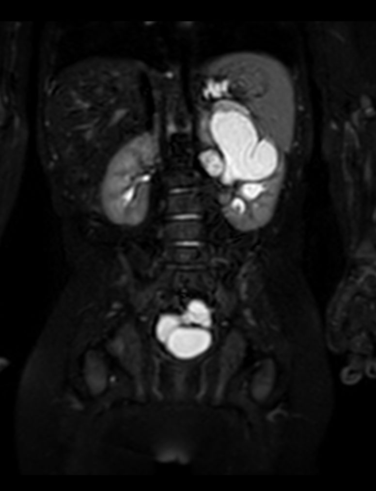 Coronal 3D VIEW T2w SPIR