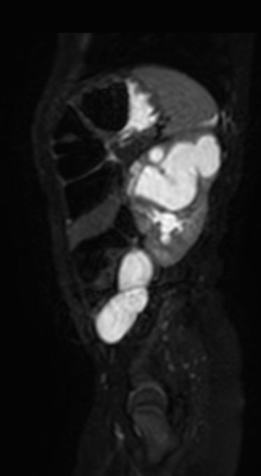 3D VIEW T2w SPIR - Sagittal reformat
