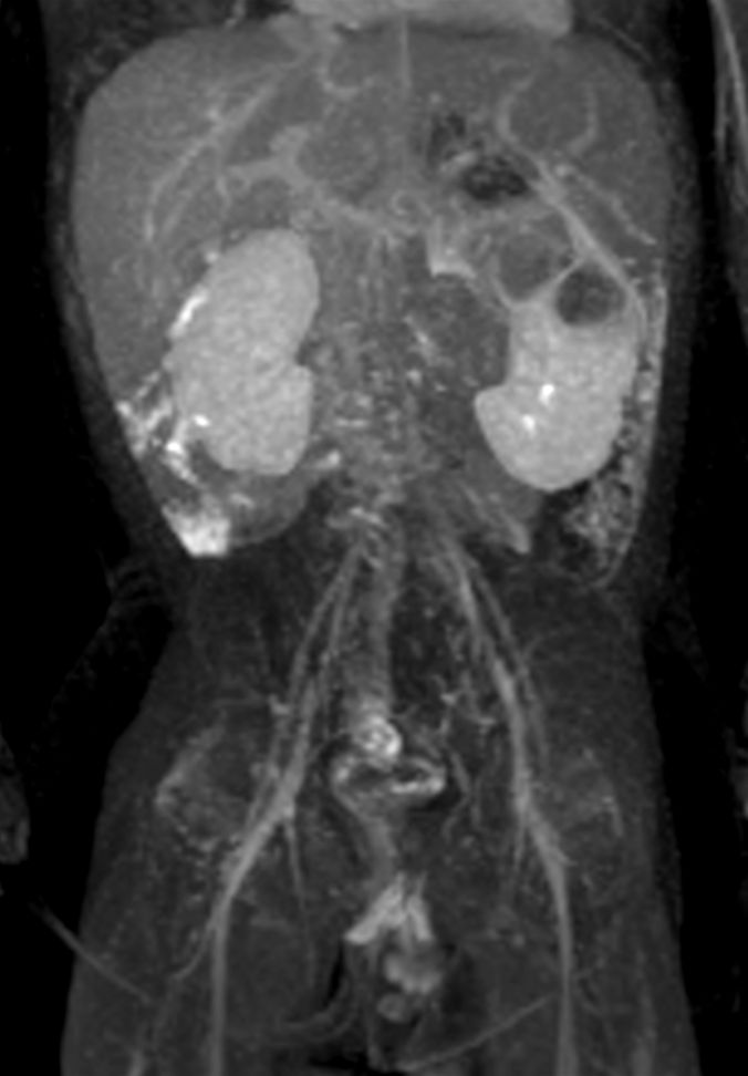 Coronal dynamic mDIXON XD - 3 min post-injection