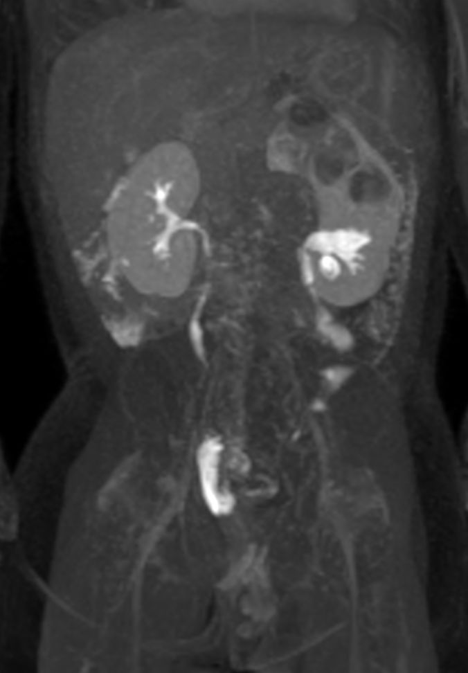 Coronal dynamic mDIXON XD - 6 min post-injection