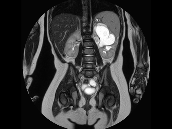 Coronal T2w MultiVane XD