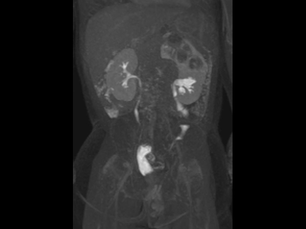 Coronal dynamic mDIXON XD - 9 min post-injection