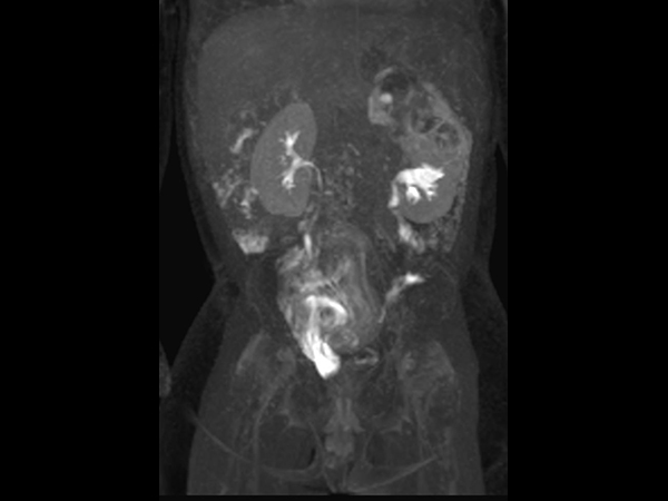 Coronal dynamic mDIXON XD - 12 min post-injection