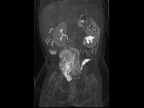 Coronal dynamic mDIXON XD - 15 min post-injection