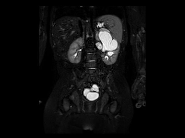 Coronal 3D VIEW T2w SPIR