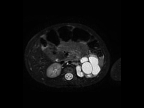 3D VIEW T2w SPIR - Axial reformat