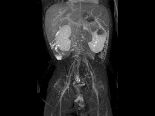 Coronal dynamic mDIXON XD - 3 min post-injection