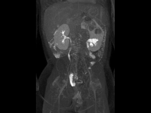 Coronal dynamic mDIXON XD - 6 min post-injection