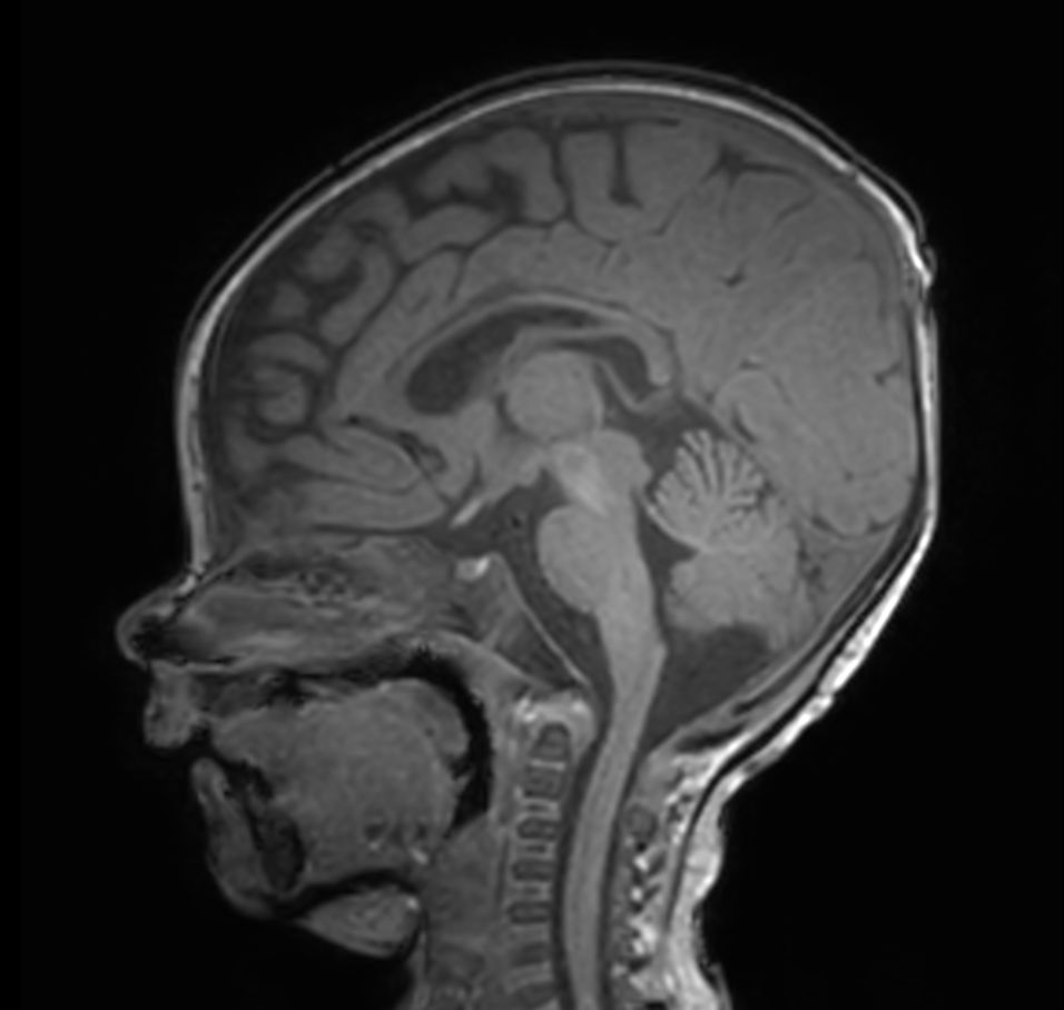 Sagittal 3D T1w TFE with ComforTone