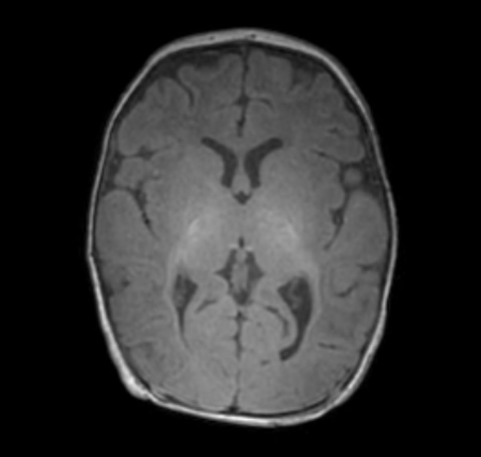 3D T1w TFE with ComforTone -  Axial reformat