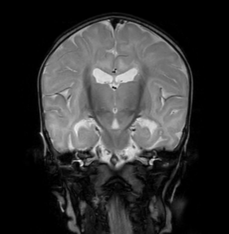 Coronal T1w IR TSE with ComforTone