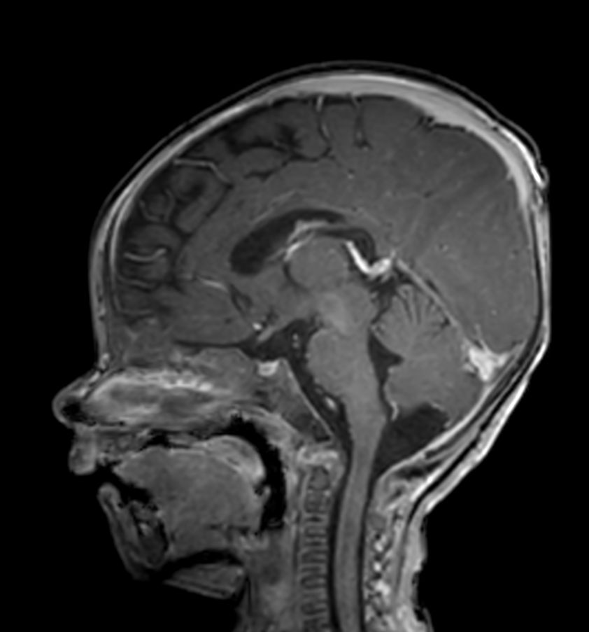Sagittal 3D T1w TFE with ComforTone (post-gado)