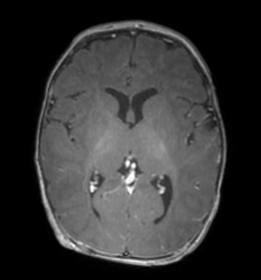 3D T1w TFE with ComforTone - Axial reformat (post-gado)