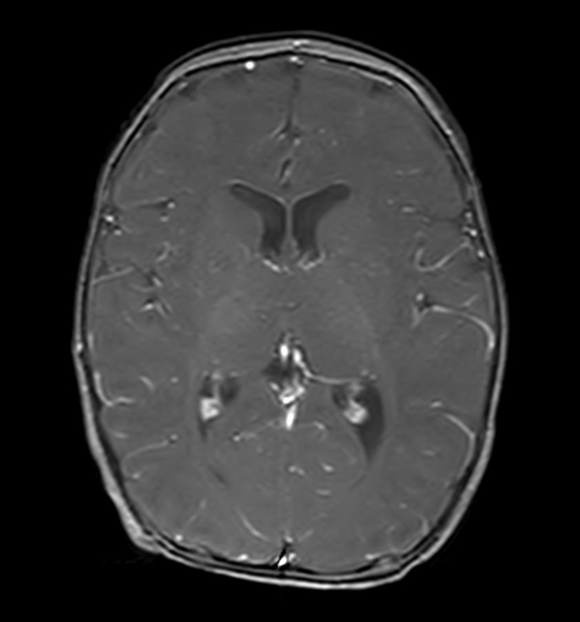 Axial T1w FFE (post-gado)