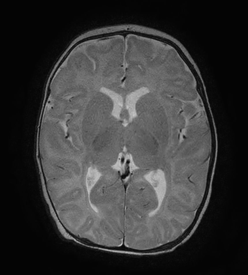 Axial T2w TSE with ComforTone