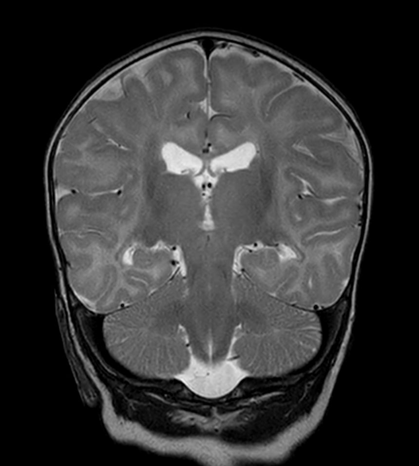 Coronal T2w TSE with ComforTone