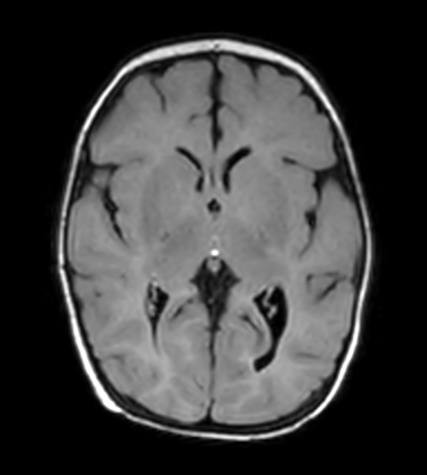 Axial T2w FLAIR with ComforTone