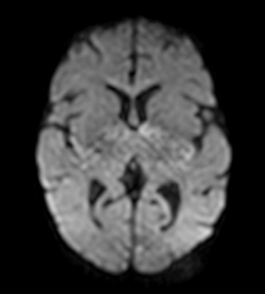 Axial DWI (b1000) with ComforTone