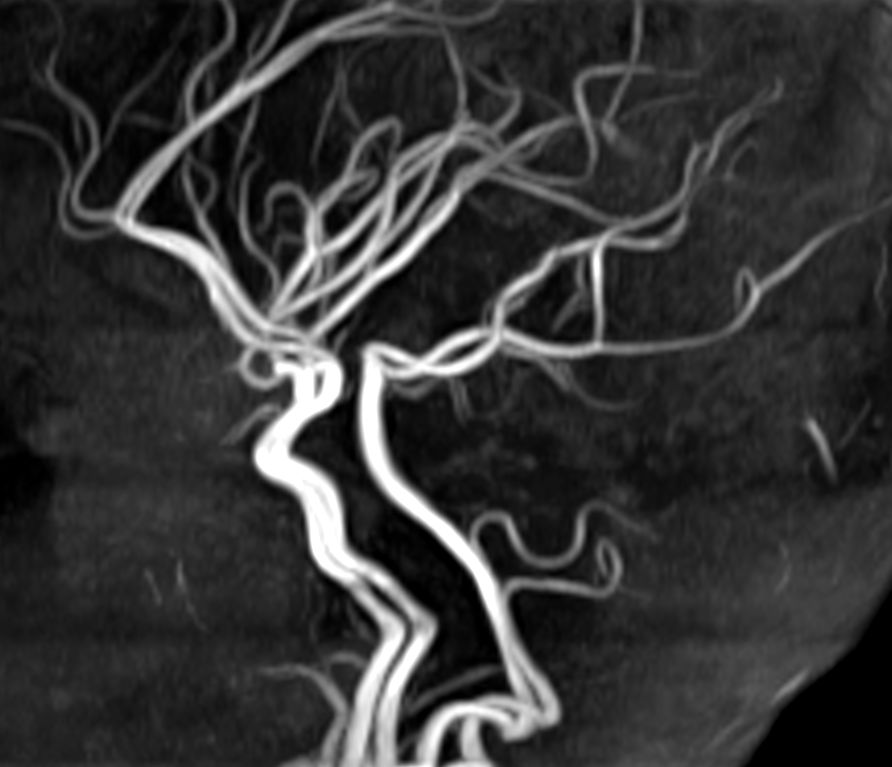 Sagittal 3D TOF (MIP)