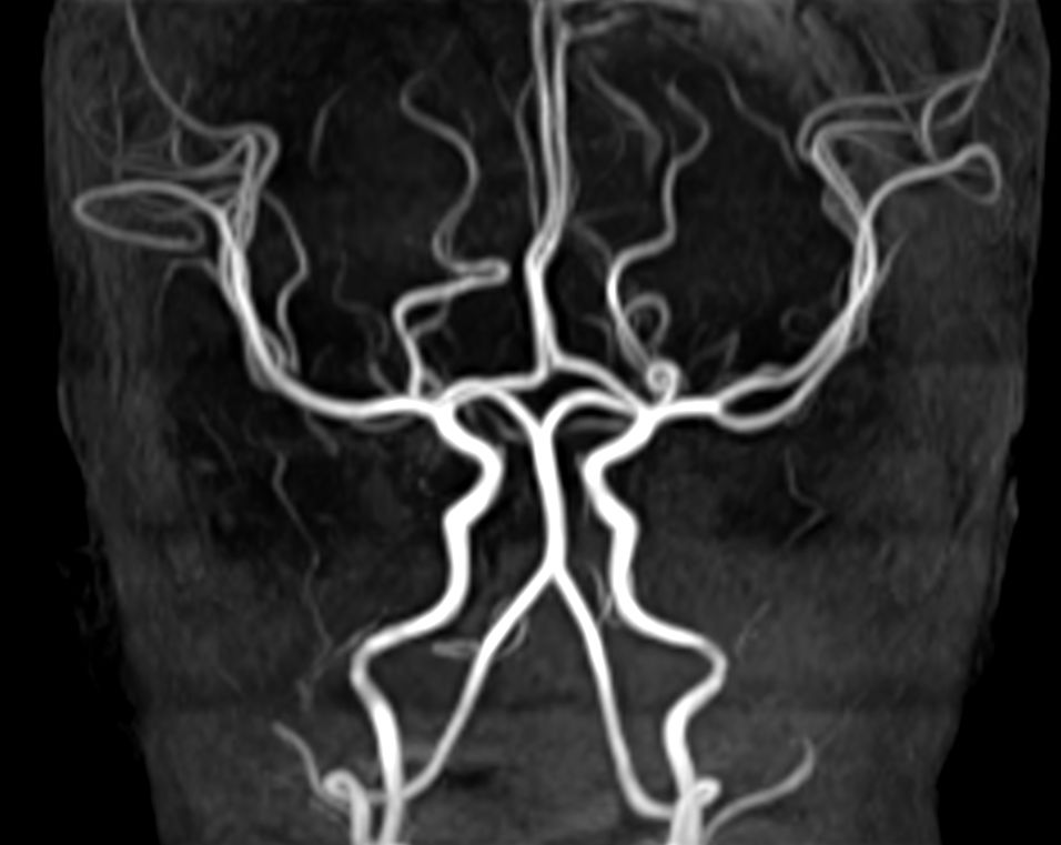 Coronal 3D TOF (MIP)