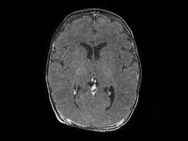 3D T1w TFE SPIR - Axial reformat (post-gado)