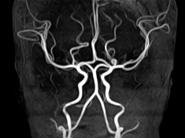 Coronal 3D TOF (MIP)