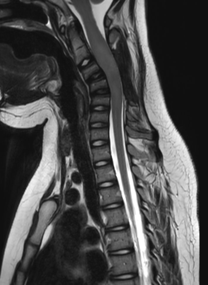 Sagittal T2w TSE (C-Spine)