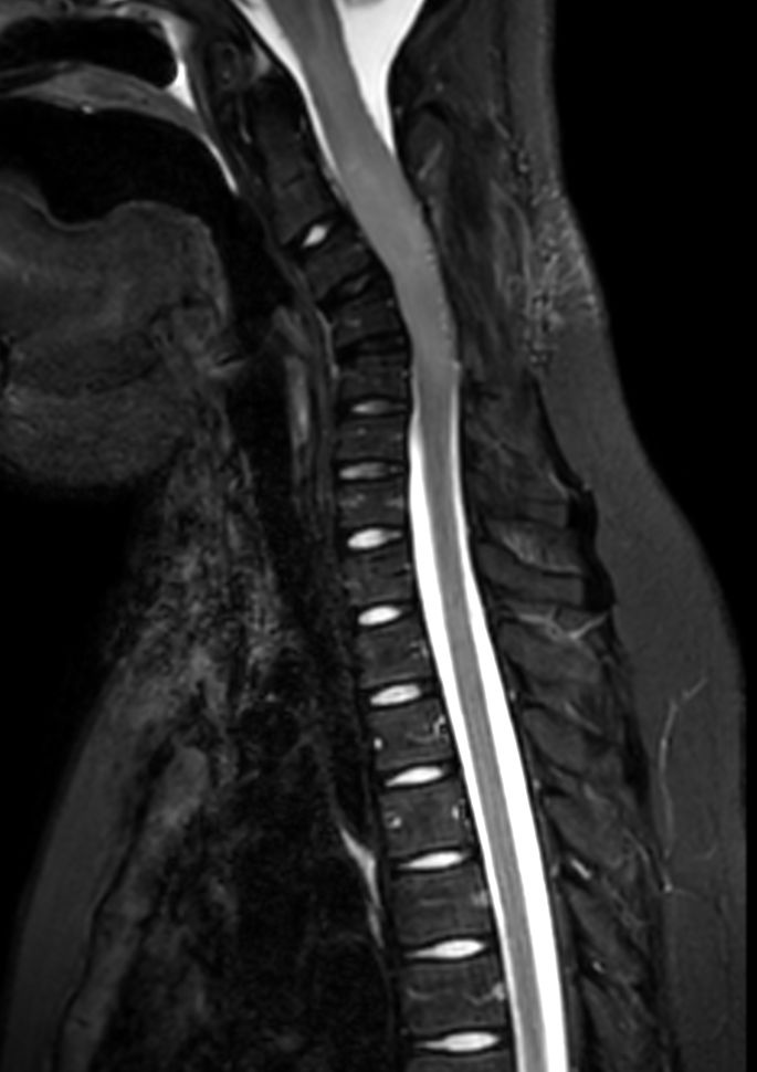 Sagittal STIR TSE