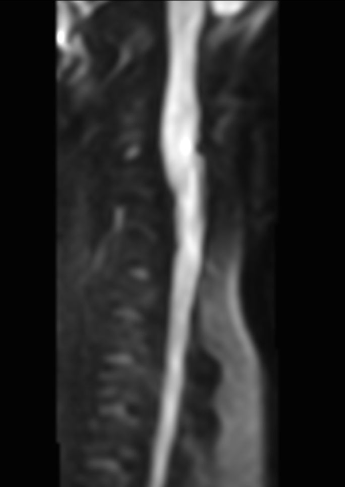 Sagittal Zoom DWI (b1000)