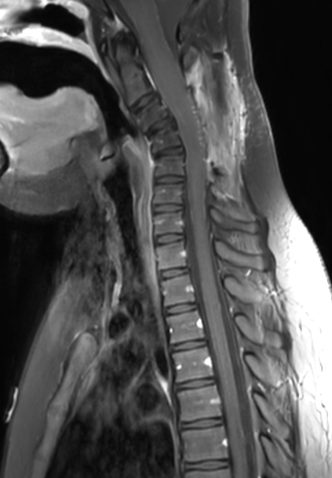 Sagittal T1w TSE SPIR (with gado)