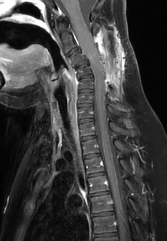 Sagittal T1w TSE mDIXON XD (Water only) (with gado)