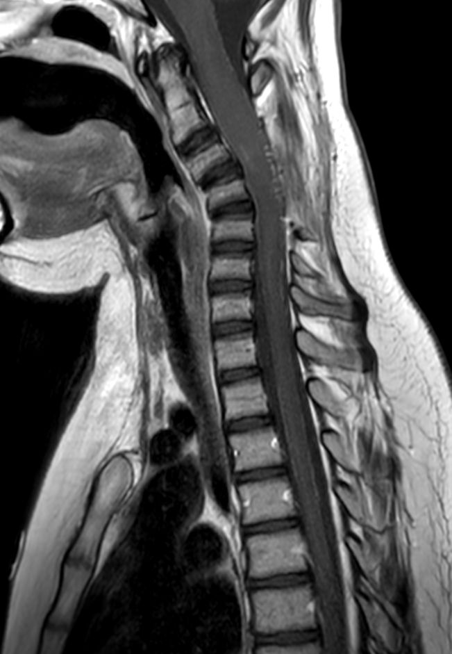 Sagittal T1w TSE mDIXON XD (In Phase) (with gado)