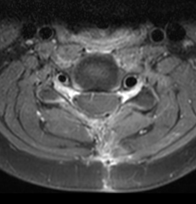 Axial T1w TSE SPIR (with gado)