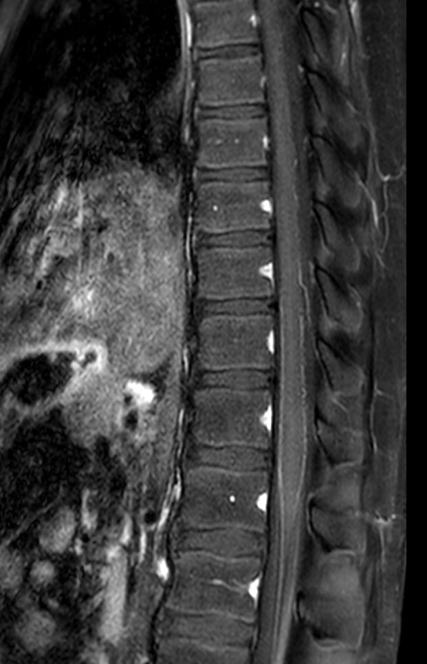 Sagittal T1w TSE mDIXON XD (Water only) (with gado)