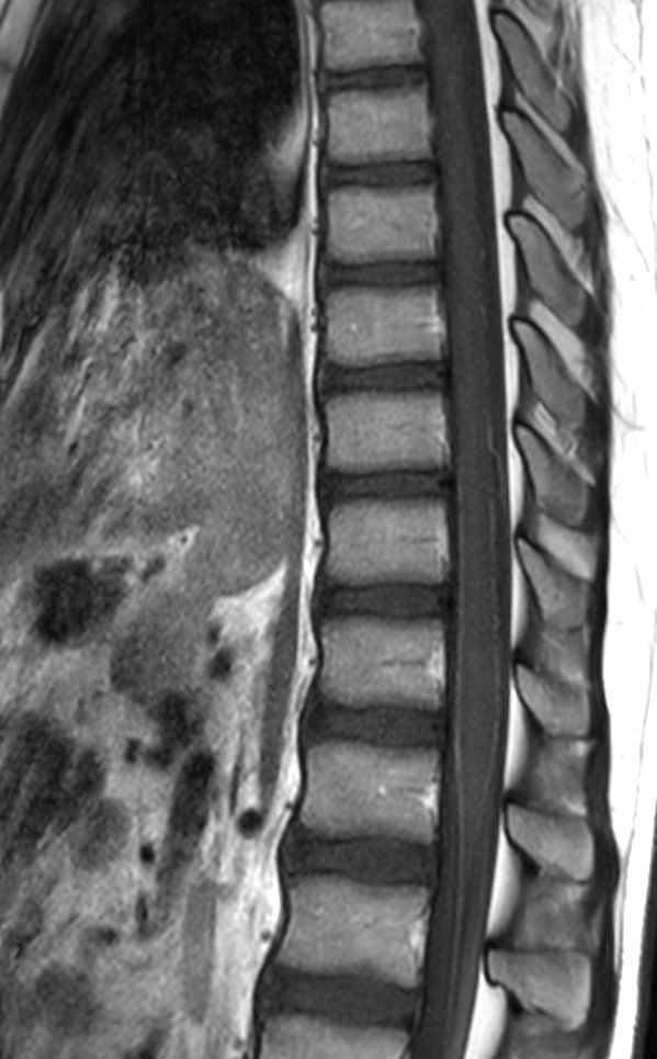 Sagittal T1w TSE mDIXON XD (In Phase) (with gado)