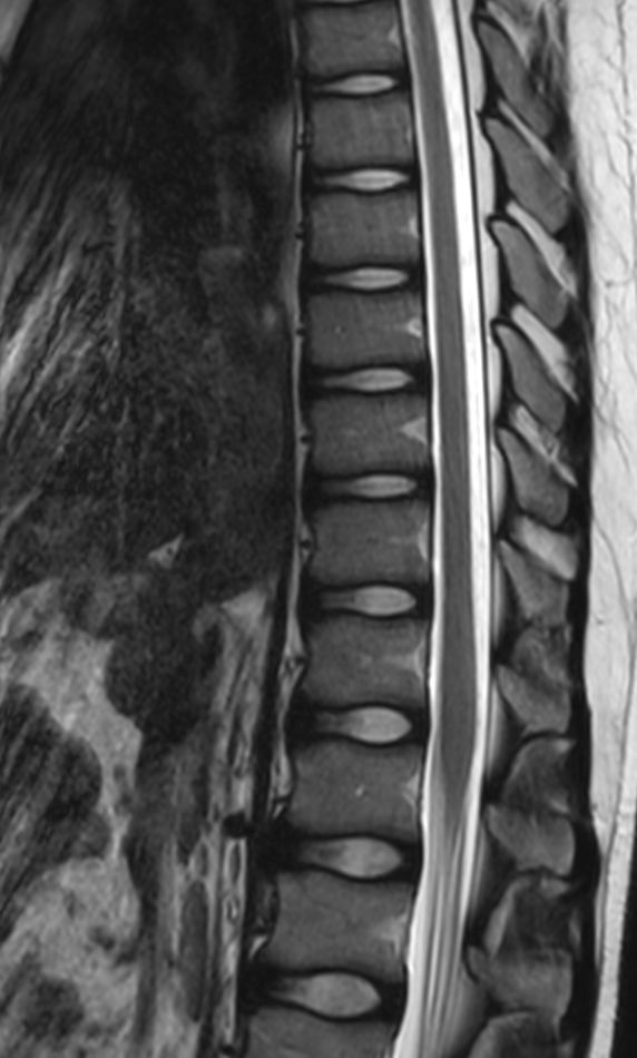 Sagittal T2w TSE (T-Spine)