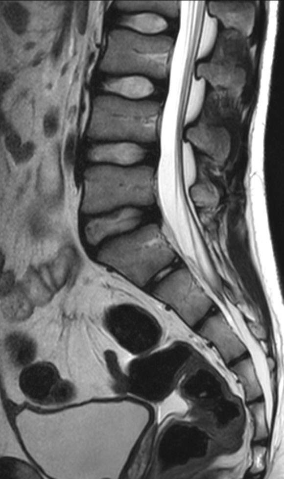 Sagittal T2w TSE (L-Spine)