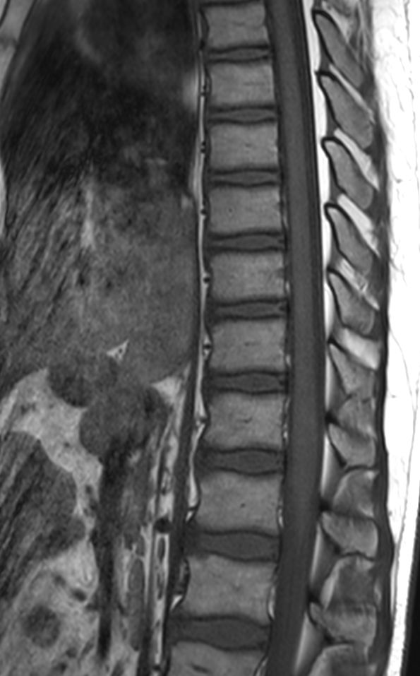 Sagittal T1w TSE (T-Spine)