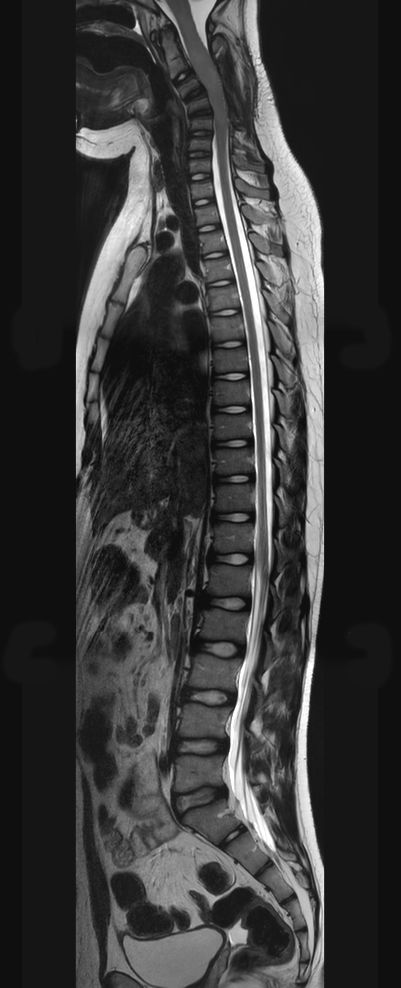 Sagittal T2w TSE (MobiView)
